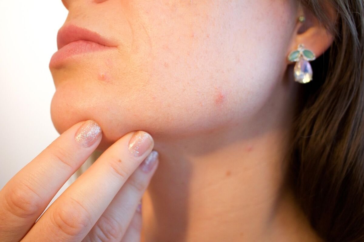 Acne en littekens behandeling